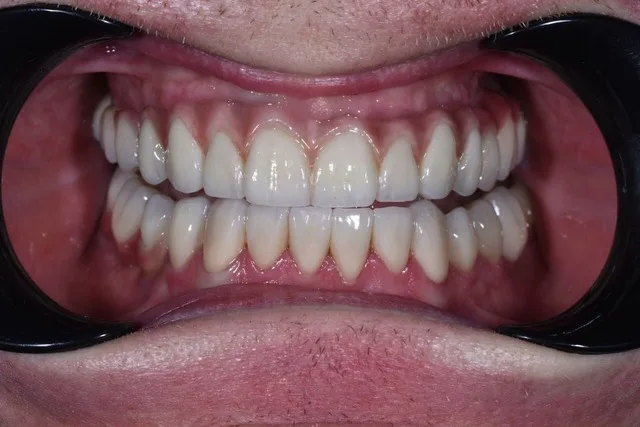 Имплантация all on 4